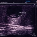 Abdominal Aortic Aneurysm