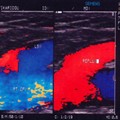 Insufficiency of the Great Saphenous Vein