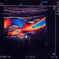 Carotid Artery Dissection