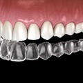Διαφανείς νάρθηκες - Invisalign