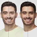 Facial asymmetry