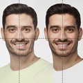 Facial asymmetry