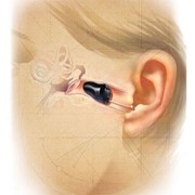 Starkey Soundlens - The smallest hearing aid in the world