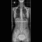 Ψηφιακή ακτινογραφία full spine