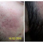 Acne scar treatment