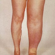 Leg Lymphedema