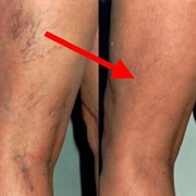 Repair of Telangiectasias