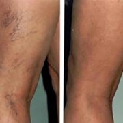 Repair of Telangiectasias