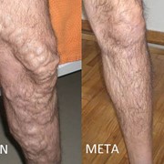 Repair of Varices
