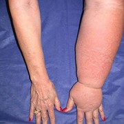 Lymphedema of the Upper Limb