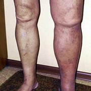 Venous Leg Thrombosis