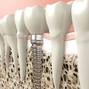 Implant