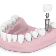 Implants