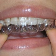 Invisalign