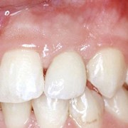 Reconstruction with an implant & connecting tissue graft
