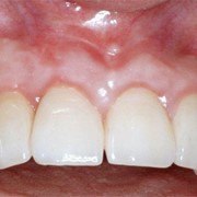 Reconstruction in the event of an accident with implants & bone grafts