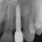 Final X-ray of the implant six years after its placement