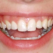 Placement of implants & gingival plastic surgery