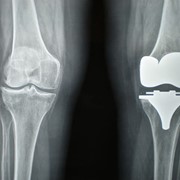 Knee replacement surgery