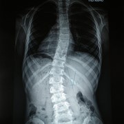 Scoliosis