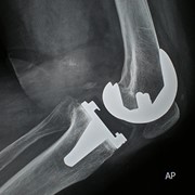 Knee replacement surgery