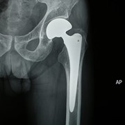 Hip replacement surgery