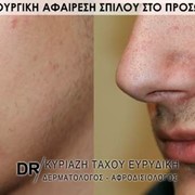 Χειρουργική αφαίρεση σπίλου στο πρόσωπο