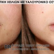 Αυξητική χειλιών με υαλουρονικό οξύ