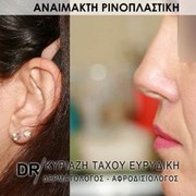 Αναίμακτη ρινοπλαστική