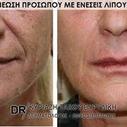 Ανανέωση προσώπου με ενέσεις λίπους