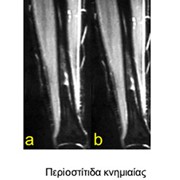 Tibial crest periostitis in an athlete