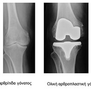 Osteoarthritis, Knee arthroplasty