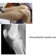 Osteochondritis of the tibial tubercle