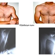 Dislocated shoulder