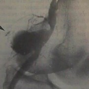 Popliteal artery aneurysm