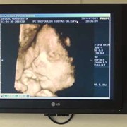 3D, 4D Ultrasound