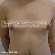 Γυναικομαστία στον άνδρα πριν