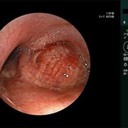Εφαρμογή επαναστατικών τεχνικών (CBCT) στη διάγνωση και αντιμετώπιση του καρκίνου του πνεύμονα