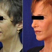 Πρόσωπο (προ και μετά)
