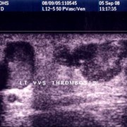 Thrombosis of the Venous Nodes of the Great Saphenous Vein