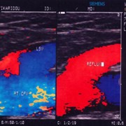 Insufficiency of the Great Saphenous Vein