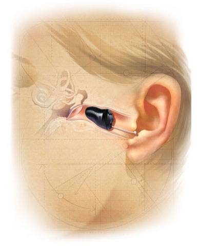 Starkey Soundlens - The smallest hearing aid in the world