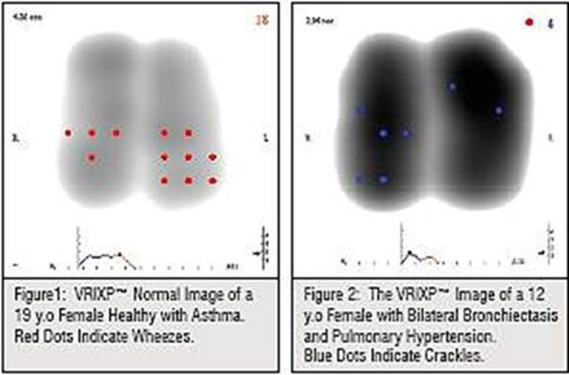 Dynamic lung ultrasound imaging