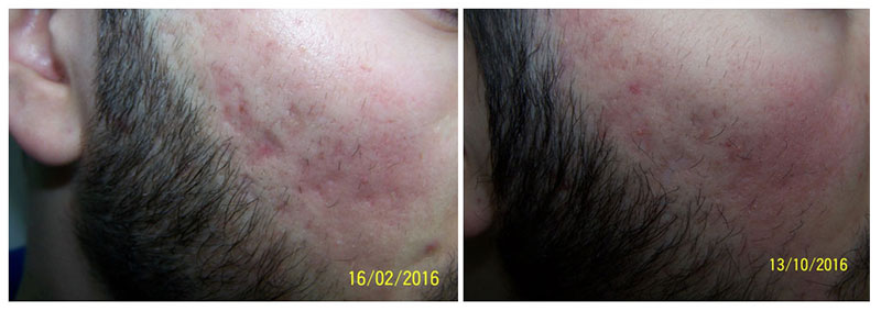 Acne scar treatment