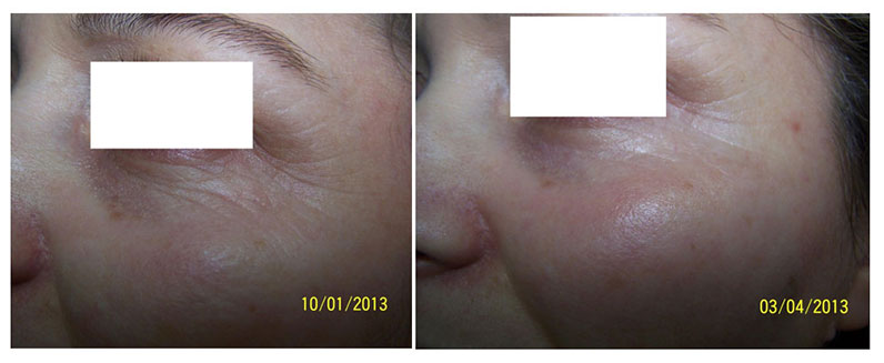Wrinkles of the lower eyelid