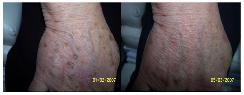 Laser spot treatment