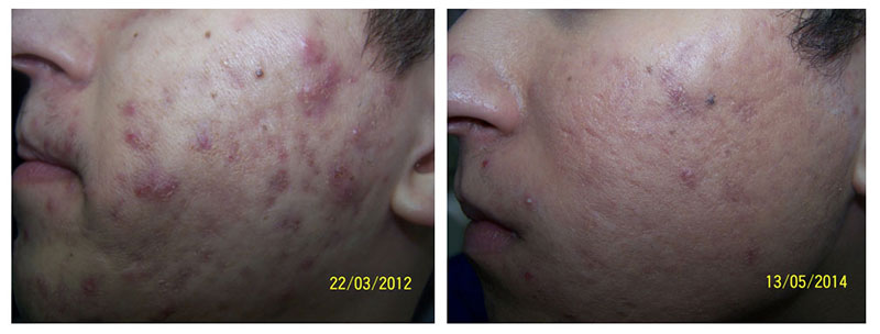 Photodynamic acne treatment