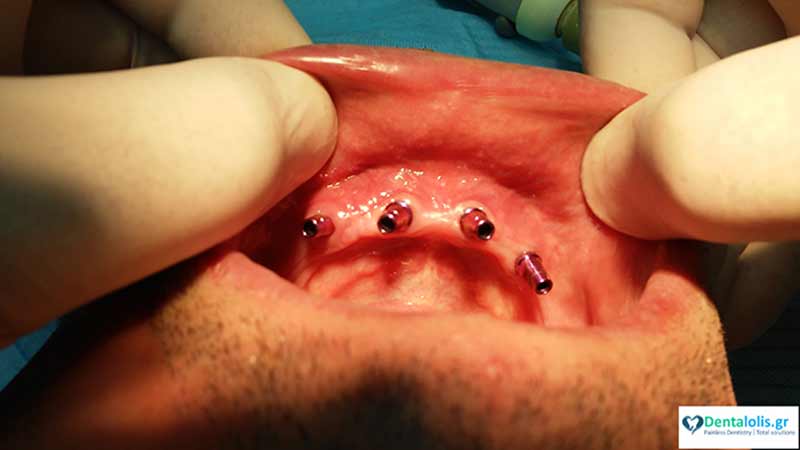 DENTALOLIS.GR - SYGCHRONES ODONTIATRIKES ERGASIES LOLIS EVAGGELOS & LOLIS ANTREAS EE: Φωτογραφίες & Βίντεο