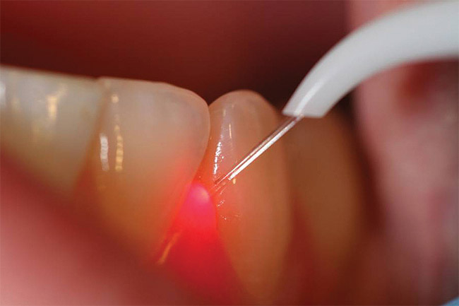 Teeth Laser Treatments