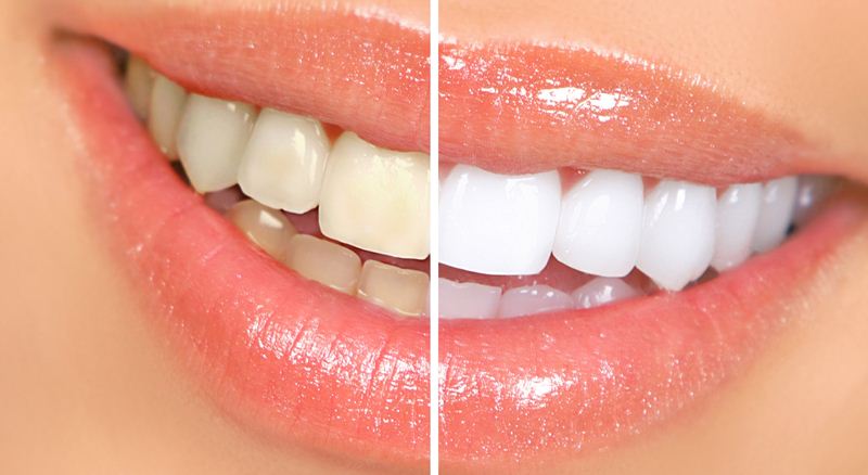 Teeth whitening